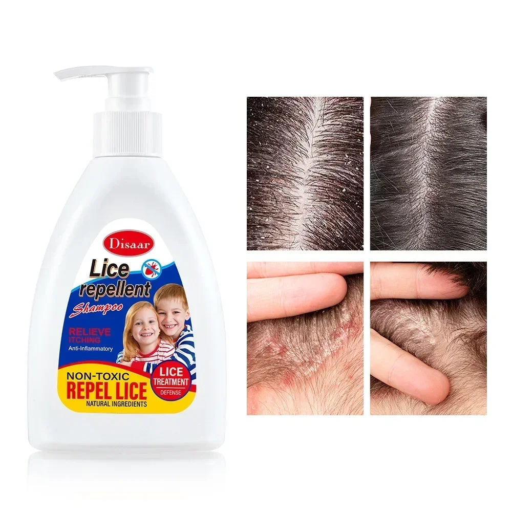 Champú para eliminar piojos de 300ml, champú repelente de piojos, ingredientes naturales, limpieza profunda de raíces del cabello, limpieza del cuero cabelludo, Шампунь Для Волос