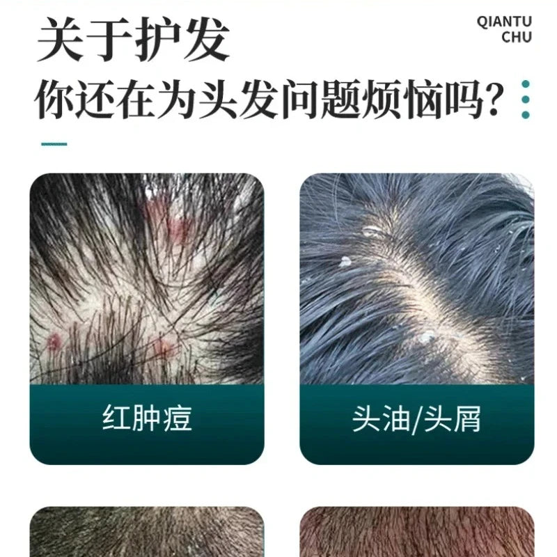 Champú anticaspa y antipicazón, cuidado del cabello a base de hierbas chinas, foliculitis de ácaros, champú seco para el cuero cabelludo seborreico, шампунь для